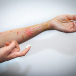 Do You Have Burn Injuries?